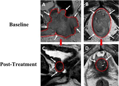 First-line pembrolizumab plus androgen deprivation therapy for locally advanced microsatellite instability-high prostate cancer in a patient with Muir-Torre syndrome: A case report